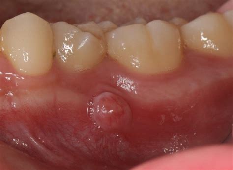 牙齦 膿包 抗生素